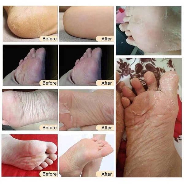 SUNISA Exfoliating Foot Mask