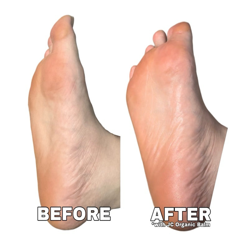 JC Callus Remover Organic Spray Solution with Foot File 100ml