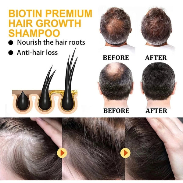 KORMESIC 5% Minoxidil with Biotin Shampoo 300ml