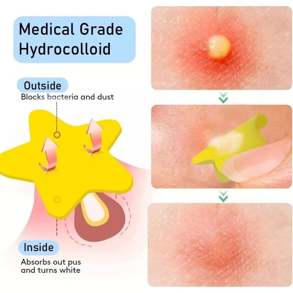 Star Pimple Patch